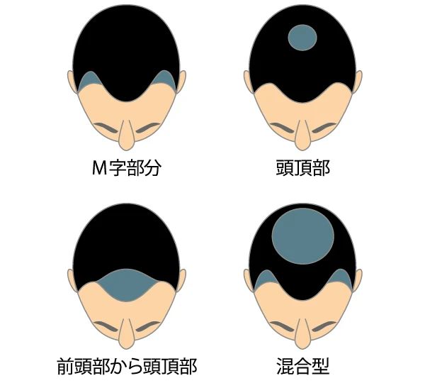 M字部分・頭頂部・前頭部から頭頂部・混合型