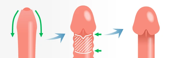 包皮が膨れる