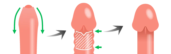 マイクロVカット法