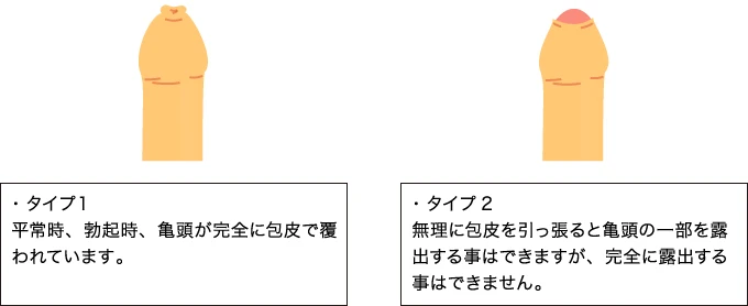 真性包茎の種類
