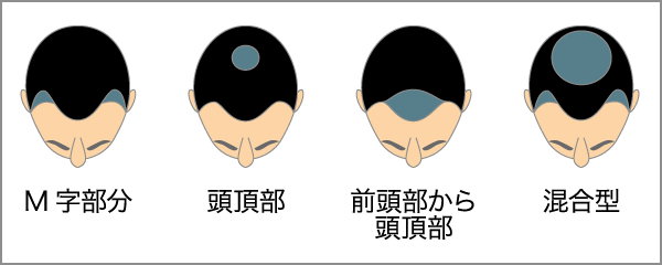 M字部分・頭頂部・前頭部から頭頂部・混合型